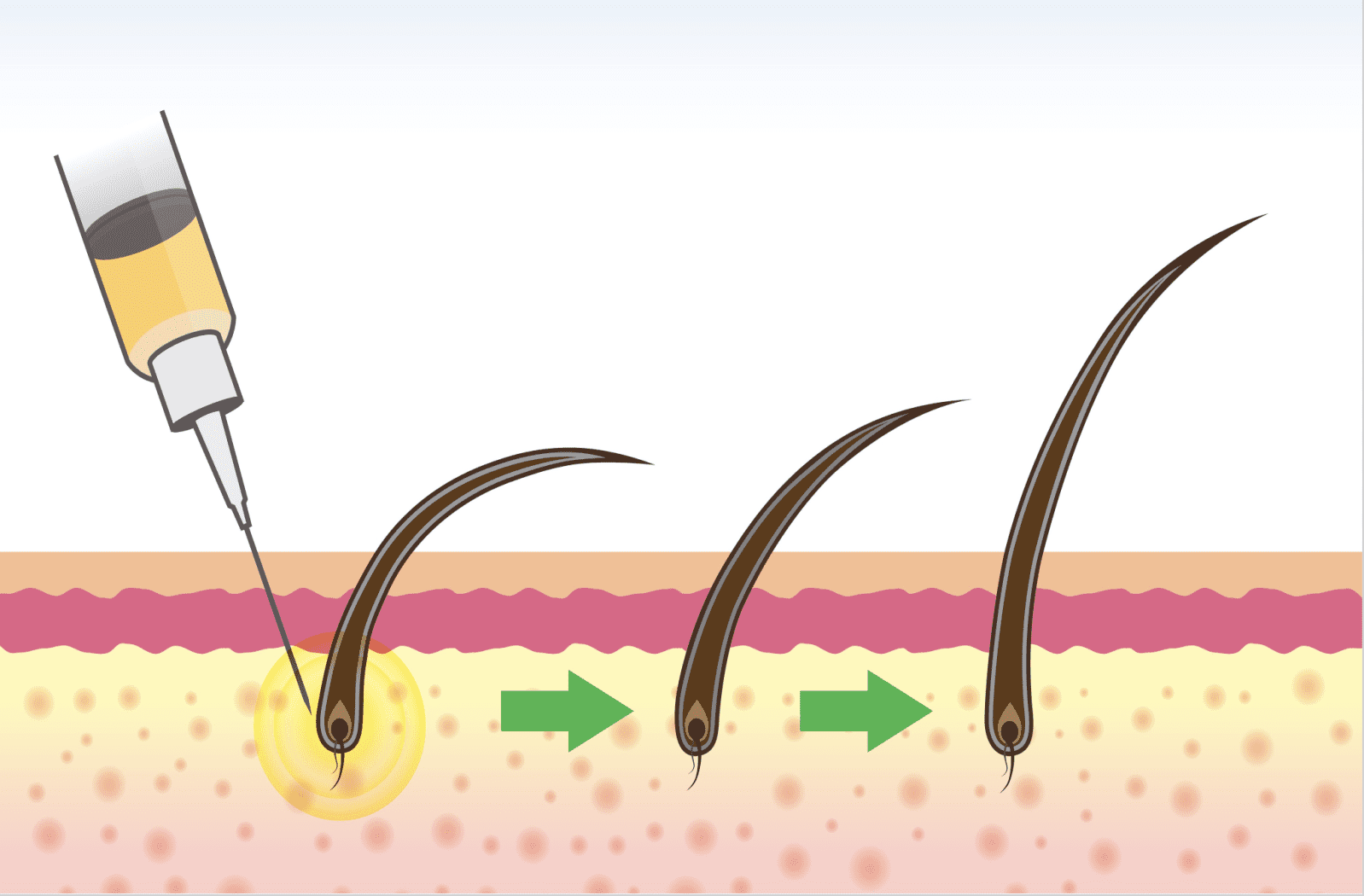 Stromal Cell Therapy for Hair Loss Developments