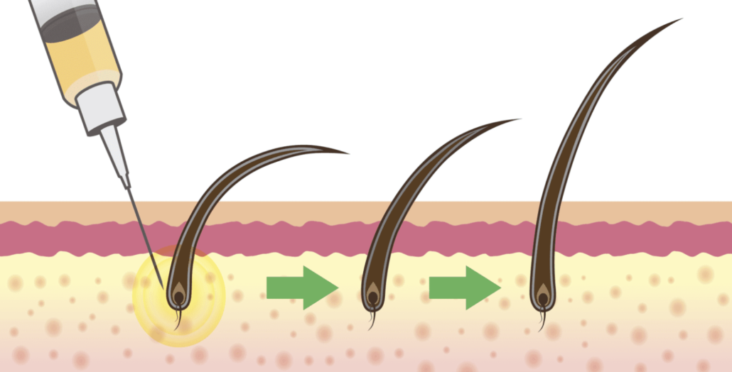 stromal cell hair injection