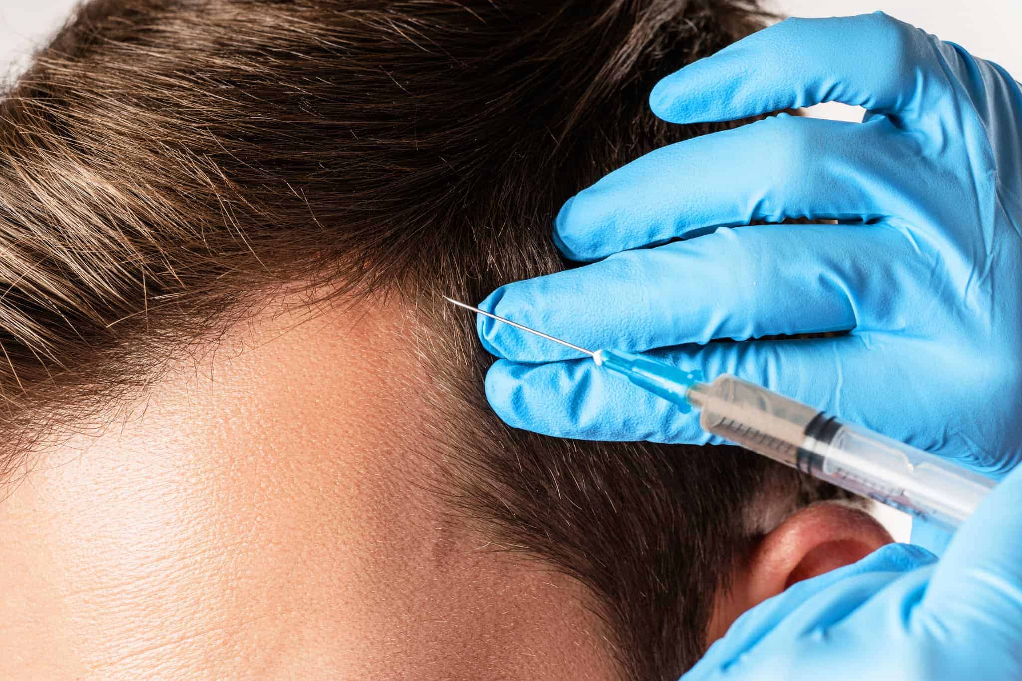 Exosomes derived from human dermal papilla cells promote hair growth in cultured human hair follicles and augment the hair-inductive capacity of cultured dermal papilla spheres