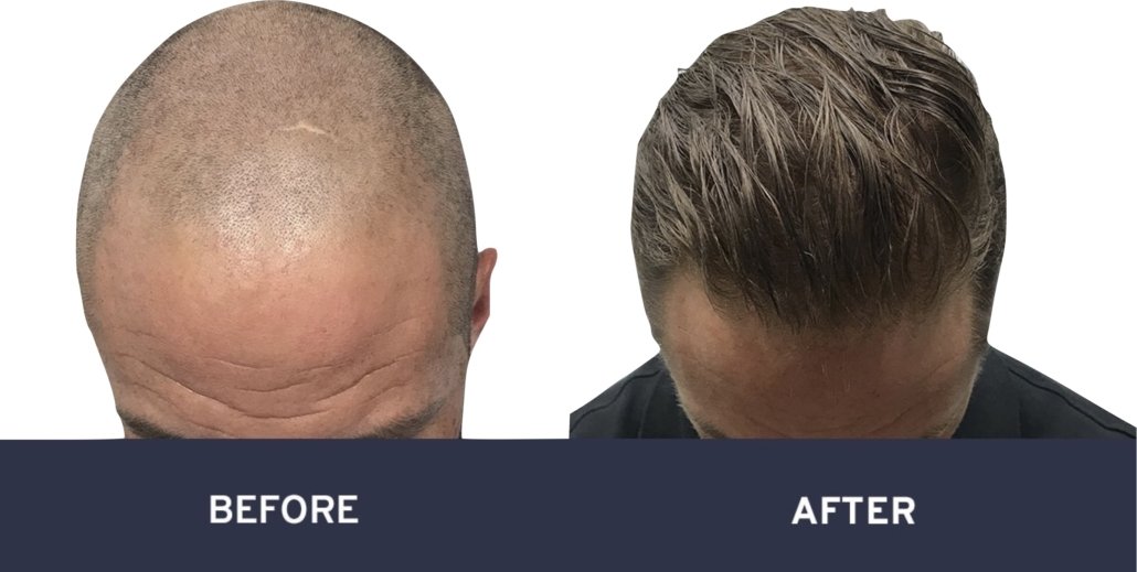 Before and after photos of hair transplant surgery #10