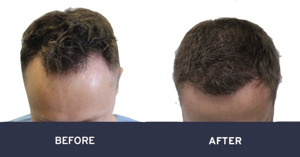 Before and after a man's hair transplant surgery #12
