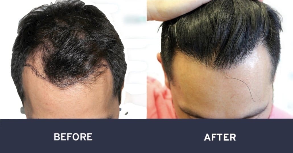 Before and after hair transplant surgery #13