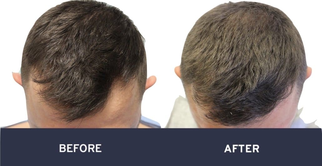 Before and after photos of FUE hair transplant #3