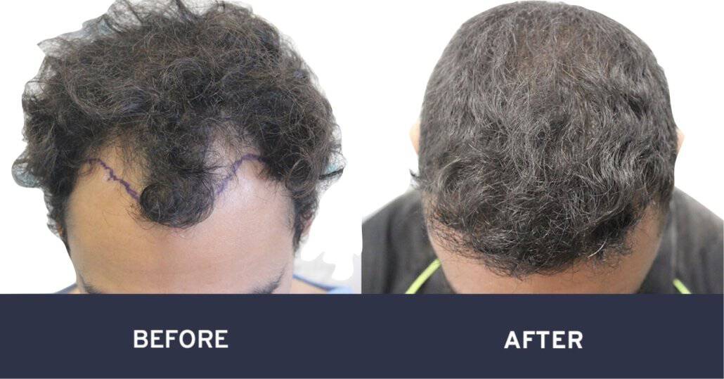 Before and after photos of FUE hair transplant #4