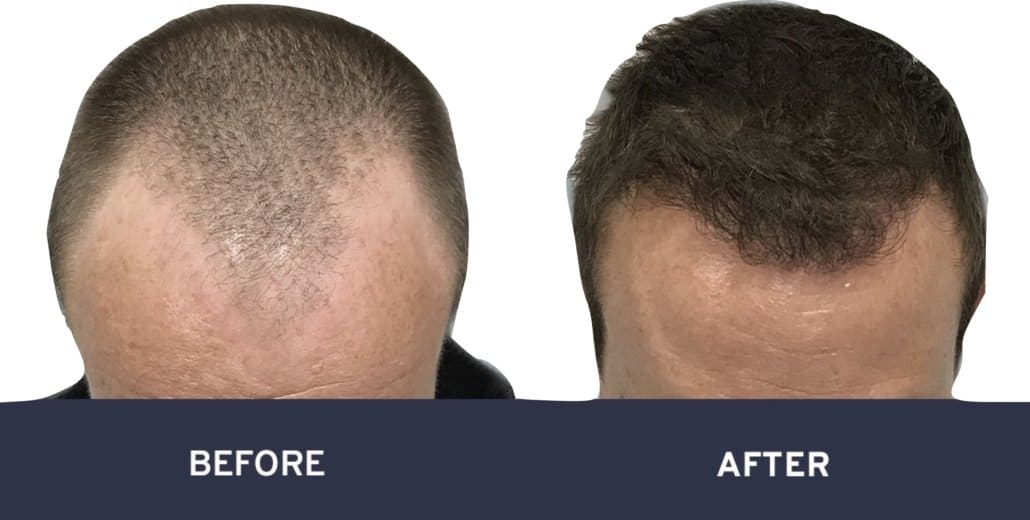 Before and after photos of FUE hair transplant #6