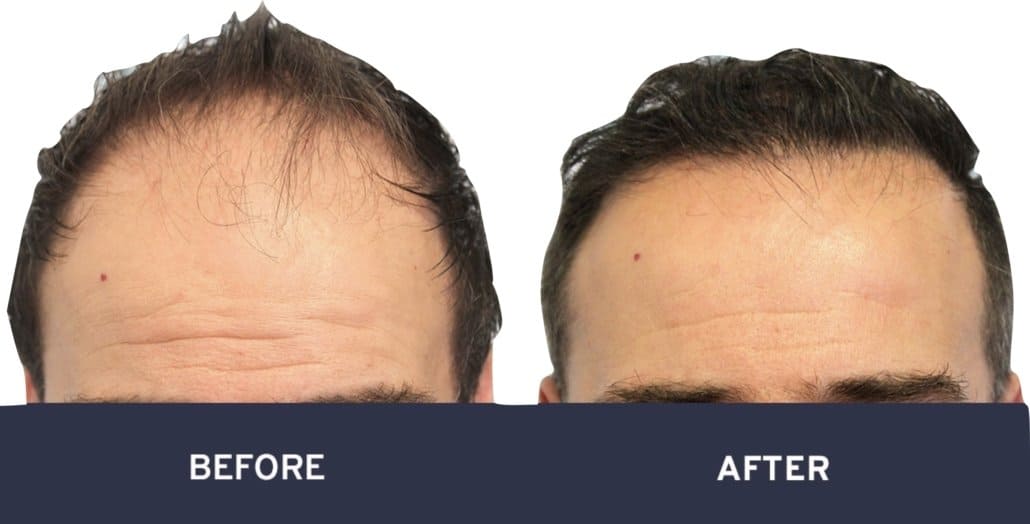 Before and after photos of FUE hair transplant #7