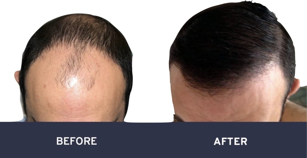 FUE hair transplant before and after photos #8
