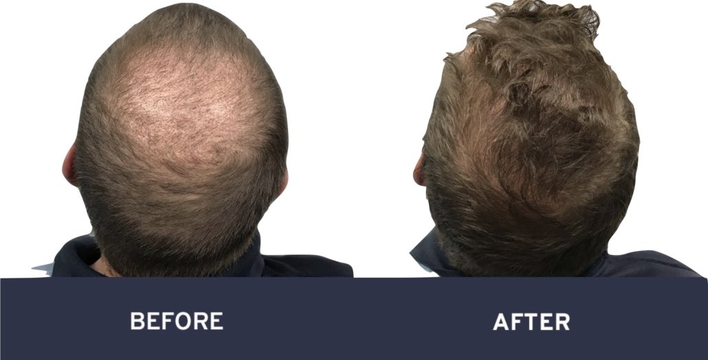 Before and after photos of stem cell hair restoration #9